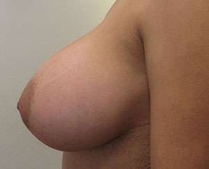 Breast Augmentation Implants Before & After Patient #7618