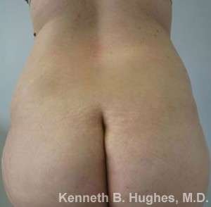 Body Lift Before & After Patient #5956