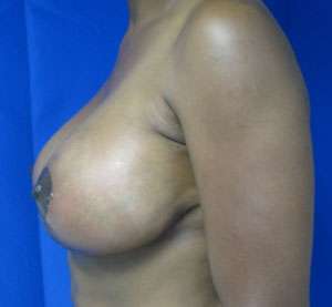 Breast Lift Before & After Patient #7927