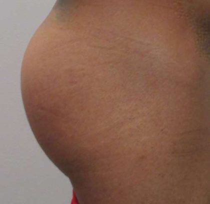 Butt Implants Before & After Patient #8186