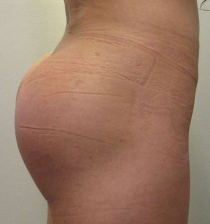 Butt Implants Before & After Patient #8193