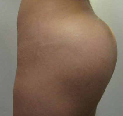 Butt Implants Before & After Patient #8214