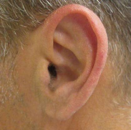 Ear Correction Before & After Patient #8373