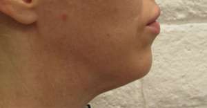 Facelift Before & After Patient #8534