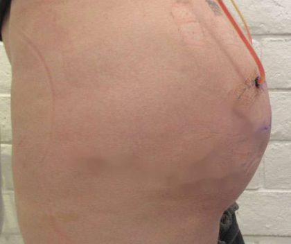 Fat Necrosis and Dead Fat Removal Before & After Patient #8586