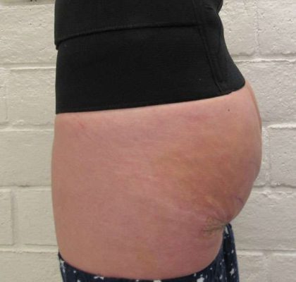 Body Lift Before & After Patient #5963