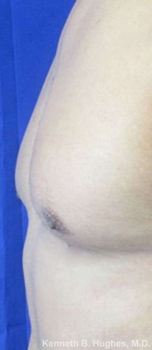 Gynecomastia Before & After Patient #8609