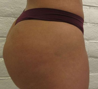 Liposuction Before & After Patient #8774