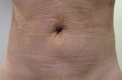 Liposuction Before & After Patient #8844