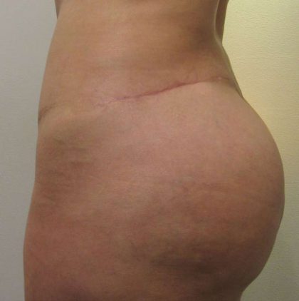 Body Lift Before & After Patient #5982