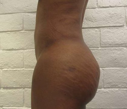 Liposuction Before & After Patient #8878