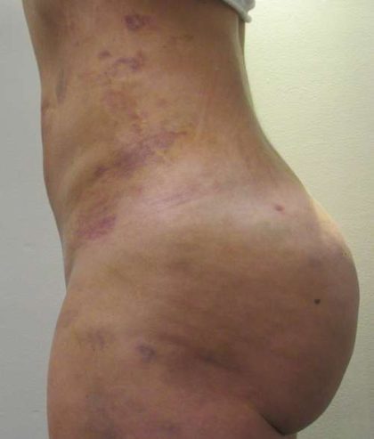 Liposuction Before & After Patient #8903