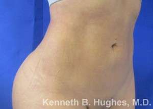 Liposuction Before & After Patient #9167