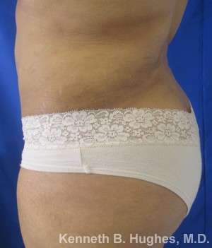 Liposuction Before & After Patient #9240