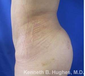 Liposuction Before & After Patient #9255