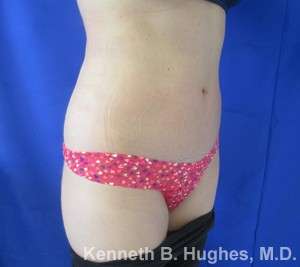 Liposuction Before & After Patient #9323