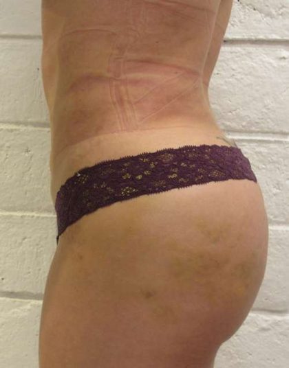 Liposuction Revision Cellulite Reduction Before & After Patient #9619