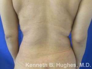 Liposuction Revision Cellulite Reduction Before & After Patient #9658