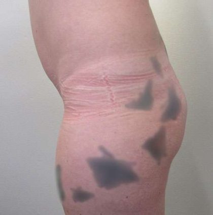 Silicone Injections Biopolymer Removal Before & After Patient #10337