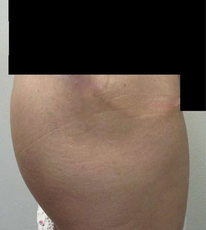 Silicone Injections Biopolymer Removal Before & After Patient #10347