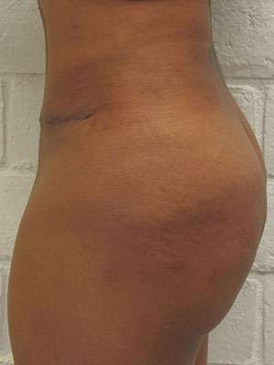 Tummy Tuck Before & After Patient #10410