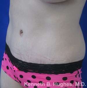 Tummy Tuck Before & After Patient #10508