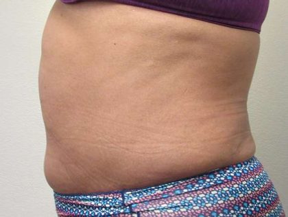 Tummy Tuck Before & After Patient #10585