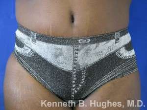 Tummy Tuck Before & After Patient #10604