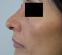 Rhinoplasty Before & After Patient #10313
