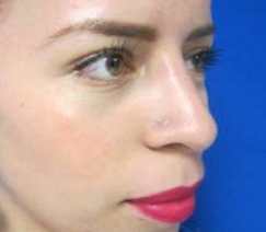 Rhinoplasty Before & After Patient #10306