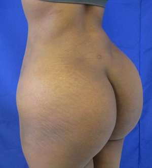 Brazilian Butt Lift Before & After Patient #6548