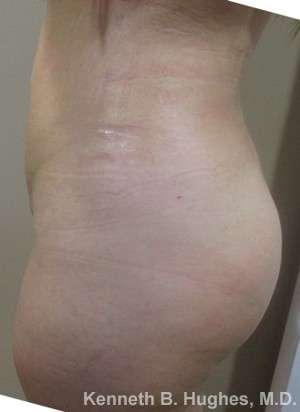 Brazilian Butt Lift Before & After Patient #6557