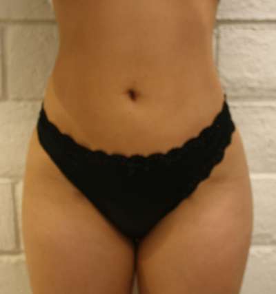 Brazilian Butt Lift Before & After Patient #6987