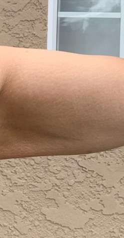 Bodytite Before & After Patient #6164