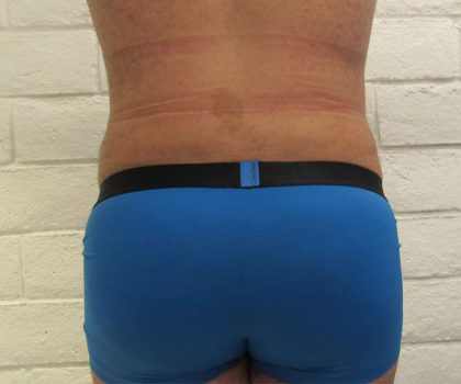 Brazilian Butt Lift Before & After Patient #6223