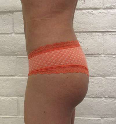 Brazilian Butt Lift Before & After Patient #6378