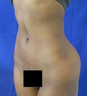Brazilian Butt Lift Before & After Patient #6548