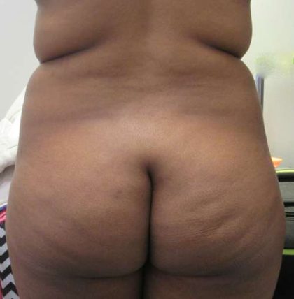 Brazilian Butt Lift Before & After Patient #6259