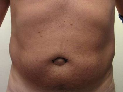 Liposuction Revision Cellulite Reduction Before & After Patient #9580