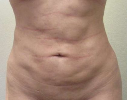 Liposuction Revision Cellulite Reduction Before & After Patient #9619