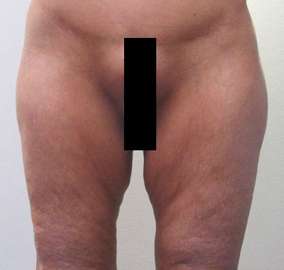 Liposuction Revision Before & After Patient #9622