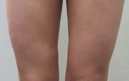 Liposuction Revision Cellulite Reduction Before & After Patient #9625