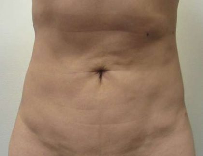 Liposuction Revision Cellulite Reduction Before & After Patient #9628