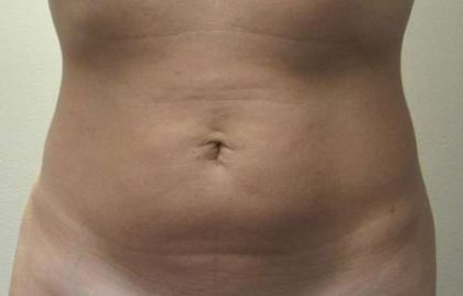 Liposuction Revision Cellulite Reduction Before & After Patient #9636