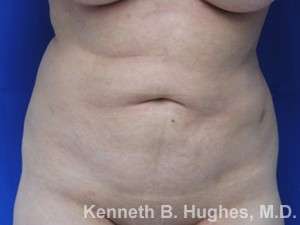 Liposuction Revision Cellulite Reduction Before & After Patient #9658