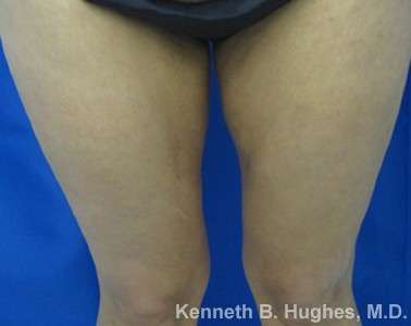 Liposuction Revision Cellulite Reduction Before & After Patient #9661