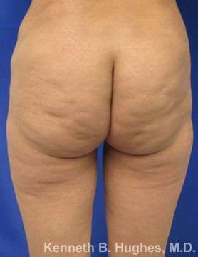 Liposuction Revision Cellulite Reduction Before & After Patient #9669