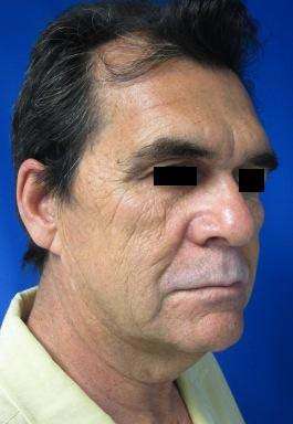 Male Brow Lift Before & After Patient #9679