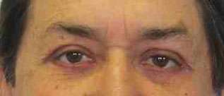 Male Eyelid Surgery Before & After Patient #9682