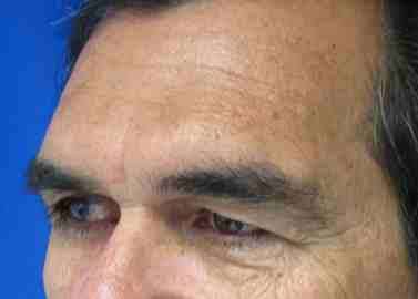 Male Eyelid Surgery Before & After Patient #9685